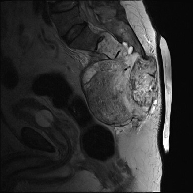 Chordoma | Radiology Reference Article | Radiopaedia.org