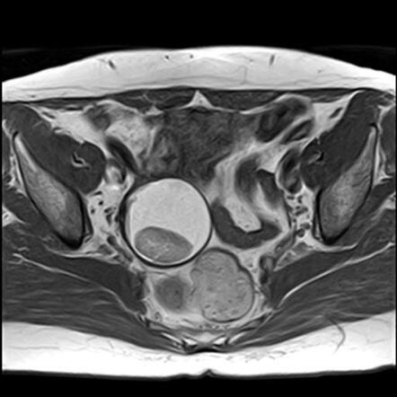 Ovarian dermoid cyst - floating ball sign | Radiology Case ...