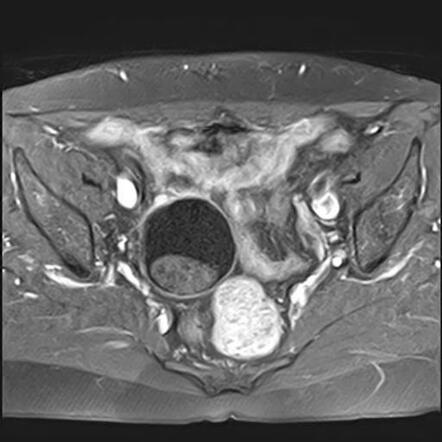 Ovarian dermoid cyst - floating ball sign | Image | Radiopaedia.org