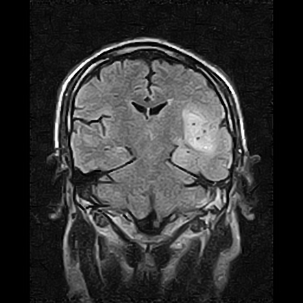 Herpes simplex encephalitis | Image | Radiopaedia.org