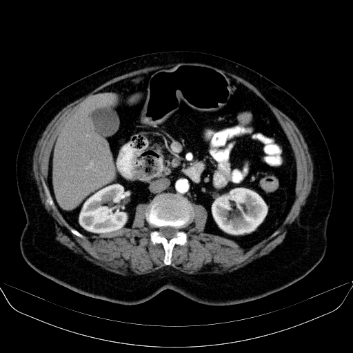 Duodenal diverticula | Image | Radiopaedia.org