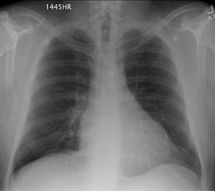 Left ventricular aneurysm | Radiology Reference Article | Radiopaedia.org