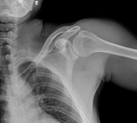 Humeral greater tuberosity fracture | Image | Radiopaedia.org