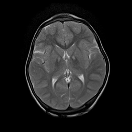 Pantothenate kinase-associated neurodegeneration | Radiology Case ...