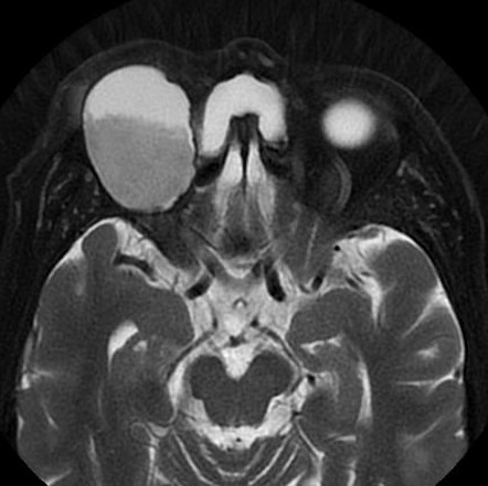 Frontal Mucocele | Radiology Case | Radiopaedia.org