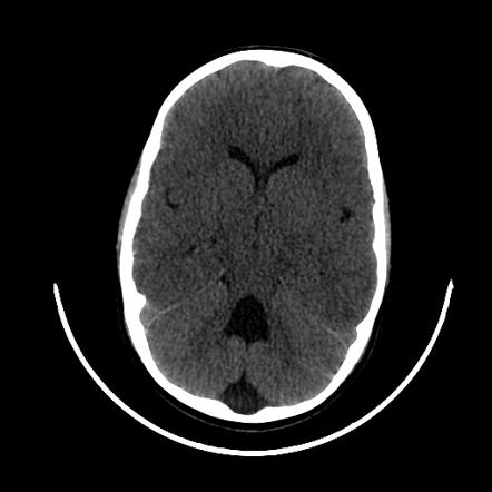 Joubert syndrome что это