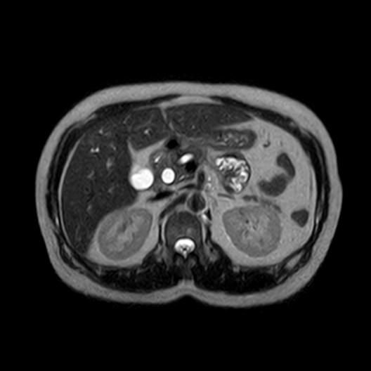 Ampullary tumor | Image | Radiopaedia.org