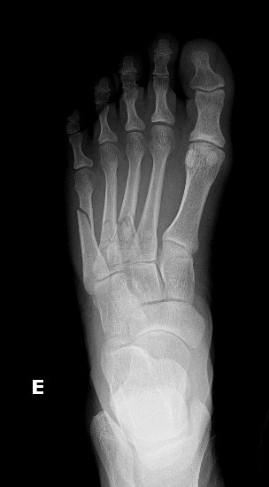 File Metatarsal Fractures 3rd 4th And 5th Radiopaedia 97587 117853 Frontal 1 Png Nc Commons