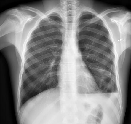 Pneumothorax | Radiology Reference Article | Radiopaedia.org