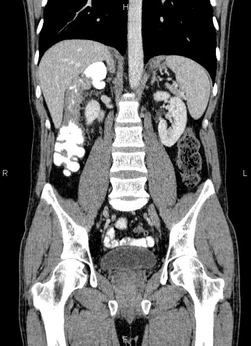 Colon adenocarcinoma | Image | Radiopaedia.org