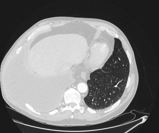 Empyema necessitans | Image | Radiopaedia.org