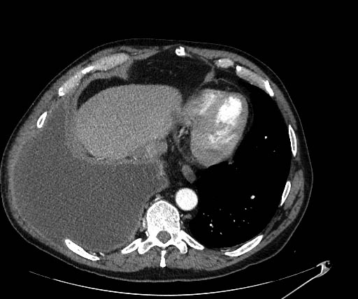 Empyema necessitans | Image | Radiopaedia.org