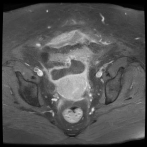 Perforated Sigmoid Diverticultis With Abscess Formation Image 5416