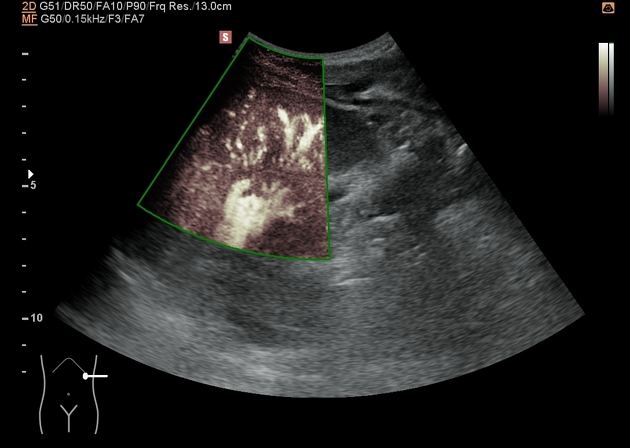 Superb microvascular imaging (ultrasound) | Radiology Reference Article ...