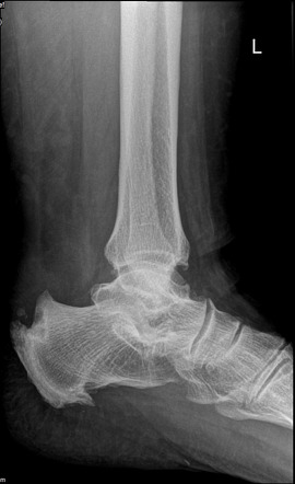 Haglund Deformity Radiology Reference Article Radiopaedia Org