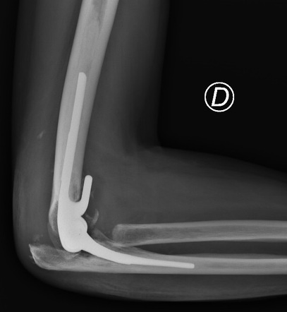 Total Elbow Arthroplasty Radiology Case Radiopaedia Org