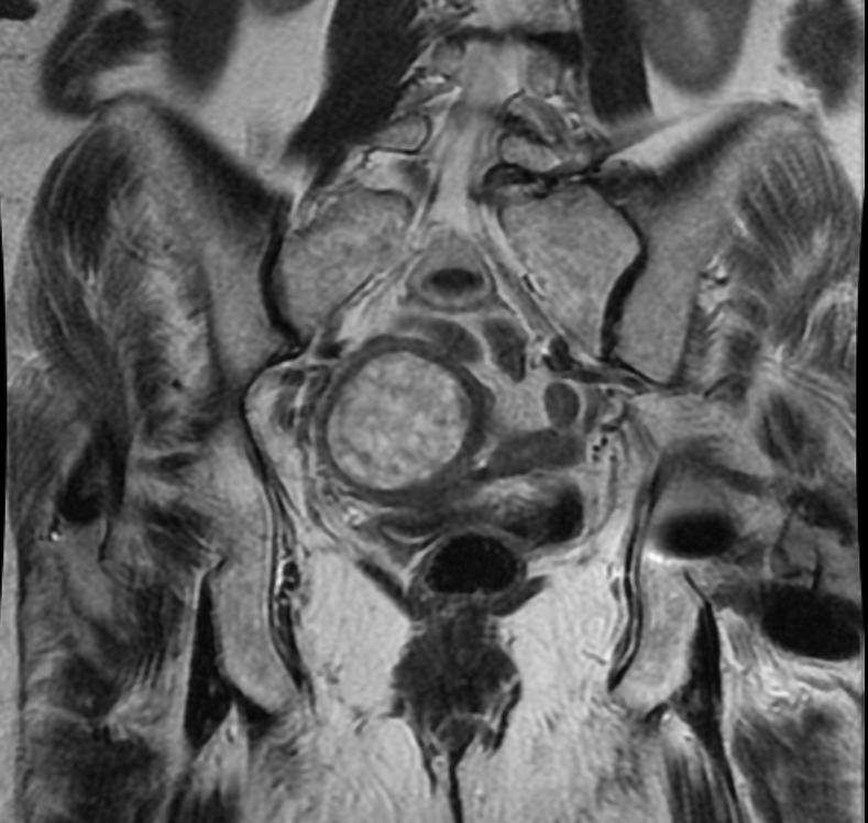 Malignant mixed mullerian tumor | Image | Radiopaedia.org