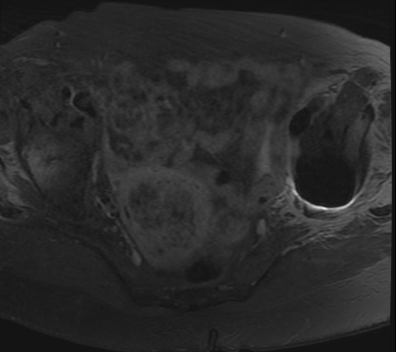 Malignant Mixed Mullerian Tumor Image 6616