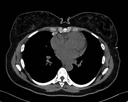 Talc pleurodesis | Image | Radiopaedia.org