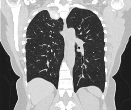 Talc pleurodesis | Image | Radiopaedia.org