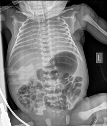 case study respiratory distress syndrome