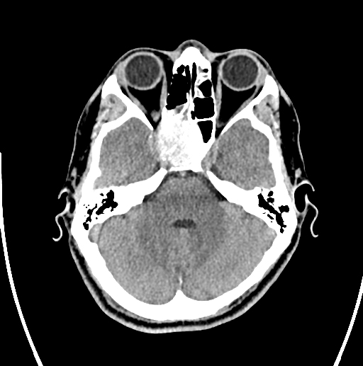 Sphenoid Sinus Mycetoma Image 