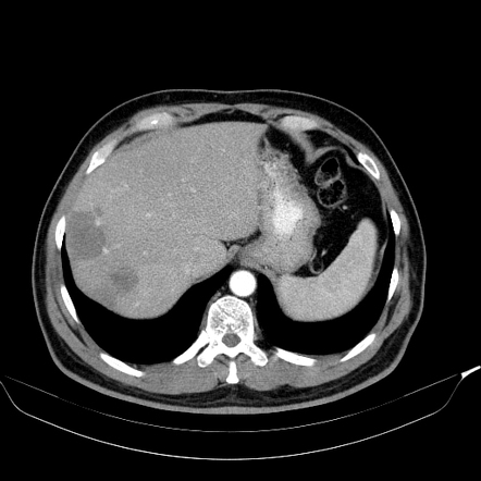 Lollipop sign (hepatic epithelioid hemangioendothelioma) | Radiology ...