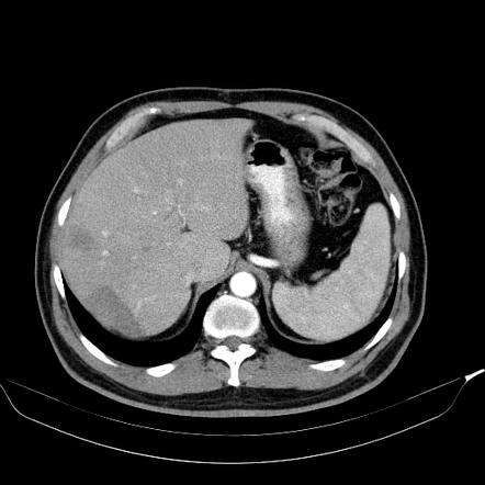 Hepatic epithelioid hemangioendothelioma | Image | Radiopaedia.org