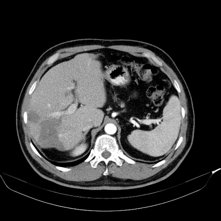 Hepatic epithelioid hemangioendothelioma | Radiology Reference Article ...