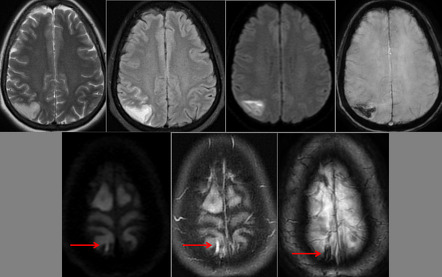 Cortical venous thrombosis with venous infarction | Radiology Case ...