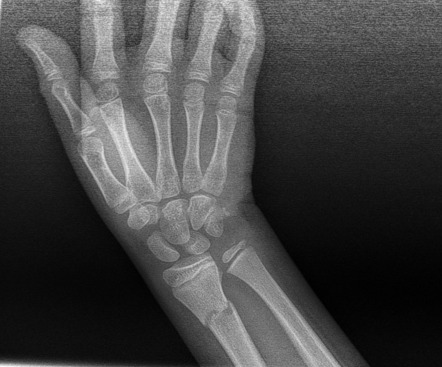 Distal radius greenstick fracture | Radiology Case | Radiopaedia.org