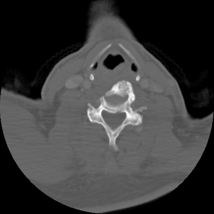 Diffuse idiopathic skeletal hyperostosis (DISH) | Image | Radiopaedia.org