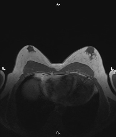 Gynecomastia | Image | Radiopaedia.org