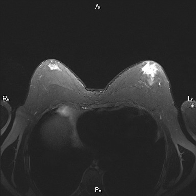 Gynecomastia Radiology Reference Article Radiopaedia