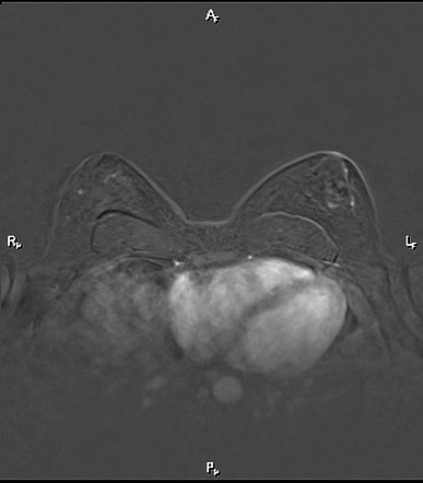 Gynecomastia | Image | Radiopaedia.org