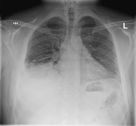 Epicardial fat necrosis | Image | Radiopaedia.org