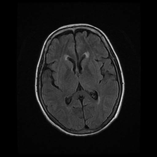 vertebral-artery-compression-syndrome-image-radiopaedia