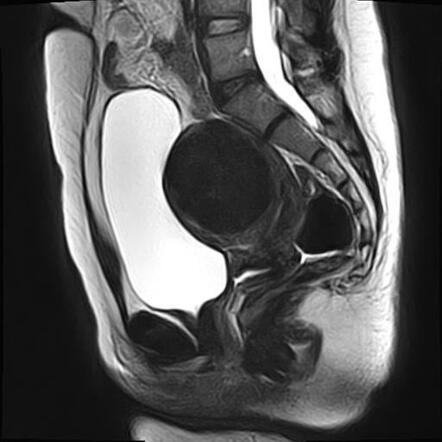 Figo Classification System For Uterine Leiomyoma Radiology Reference Article Radiopaedia Org