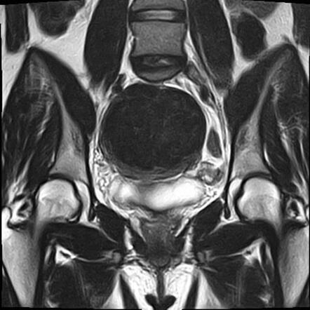 Uterine leiomyoma - FIGO type 5 | Image | Radiopaedia.org