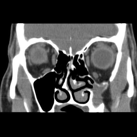 Silent sinus syndrome | Image | Radiopaedia.org