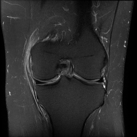 Medial collateral ligament and popliteus injuries | Radiology Case ...