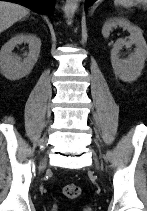 Extraforaminal disc extrusion | Image | Radiopaedia.org