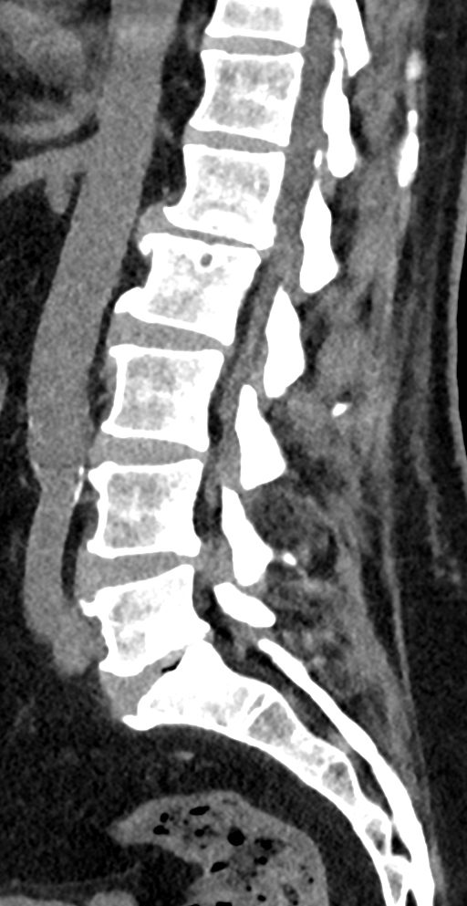 Extraforaminal disc extrusion | Image | Radiopaedia.org