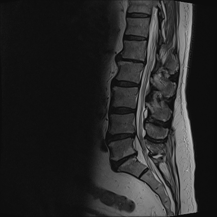 Extraforaminal disc extrusion | Image | Radiopaedia.org