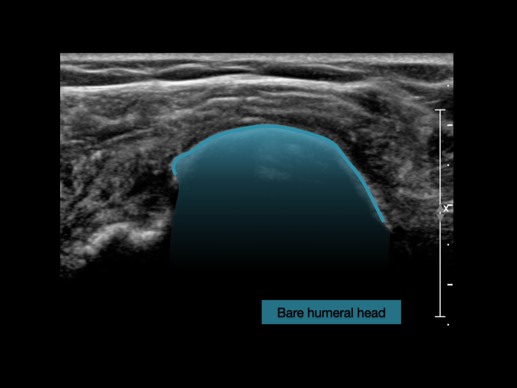 Complete supraspinatus and infraspinatus tendon tears and dislocation ...