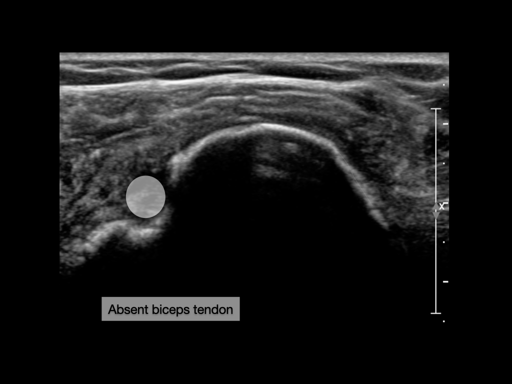 Complete supraspinatus and infraspinatus tendon tears and dislocation ...