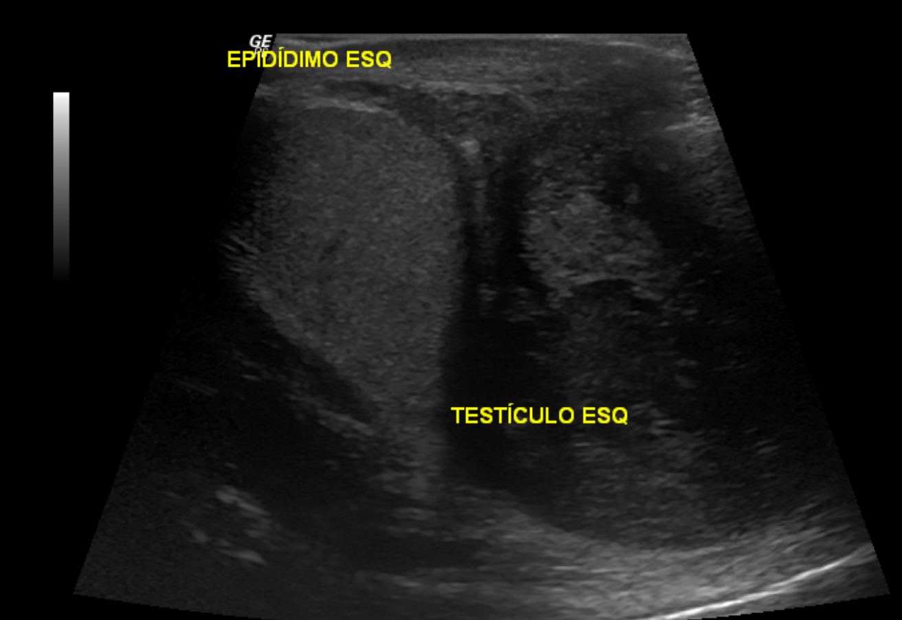 Paratesticular Rhabdomyosarcoma Image 9314