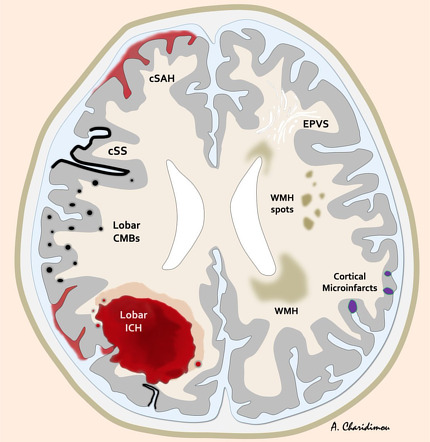 Cerebral Amyloid Angiopathy (illustration) | Radiology Case ...