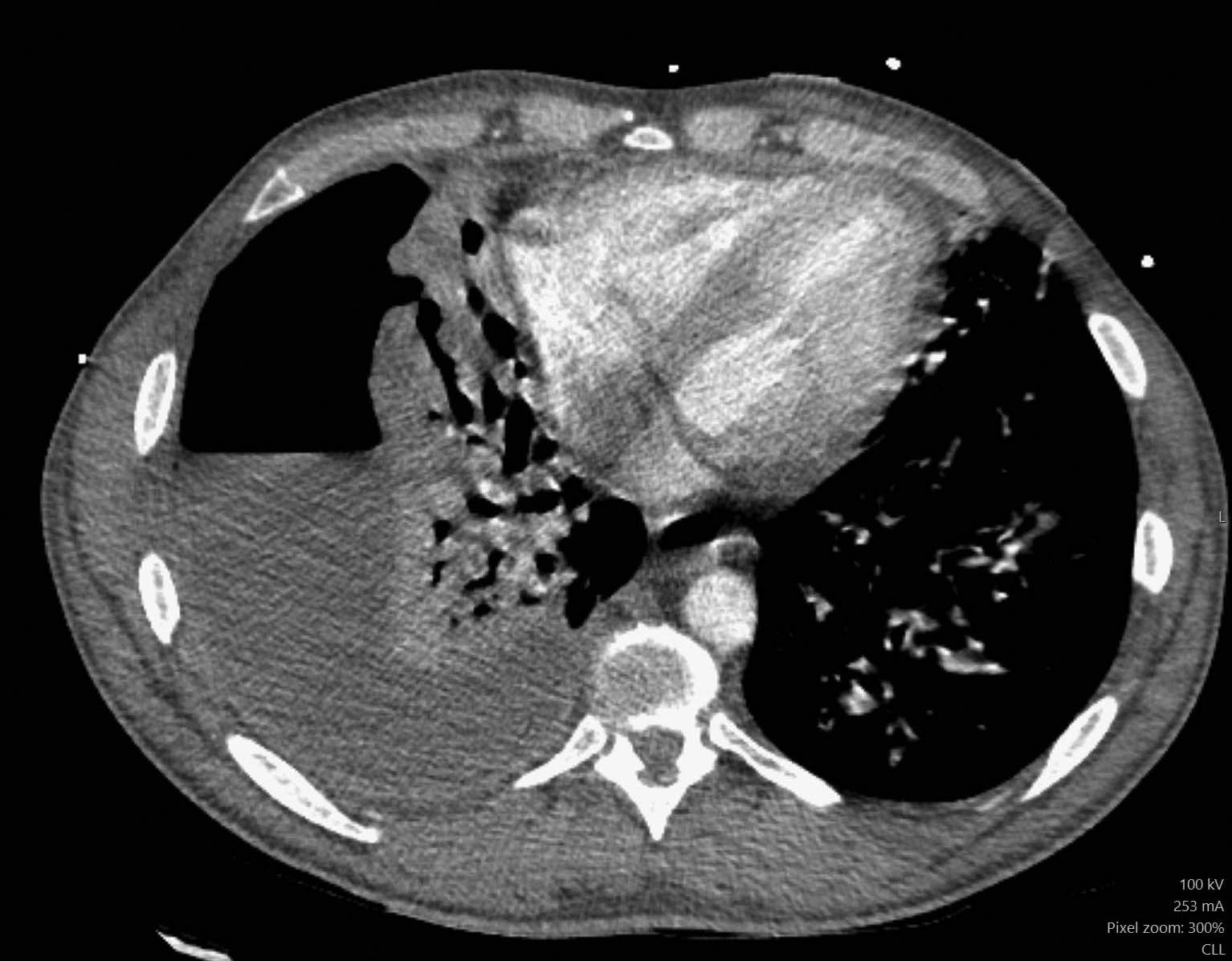 Empyema with bronchopleural fistula | Image | Radiopaedia.org