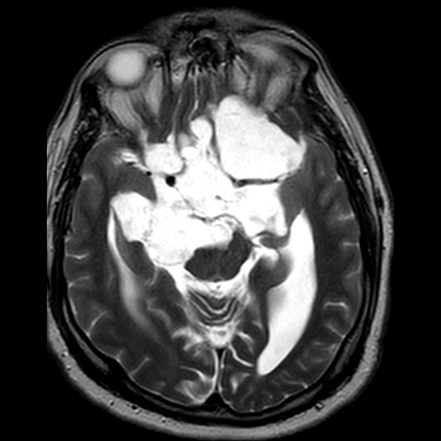 Intracranial Epidermoid Cyst Image 4070